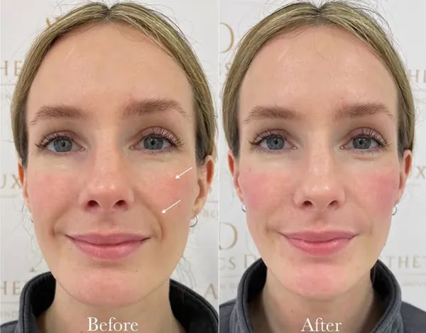 Facial contouring result