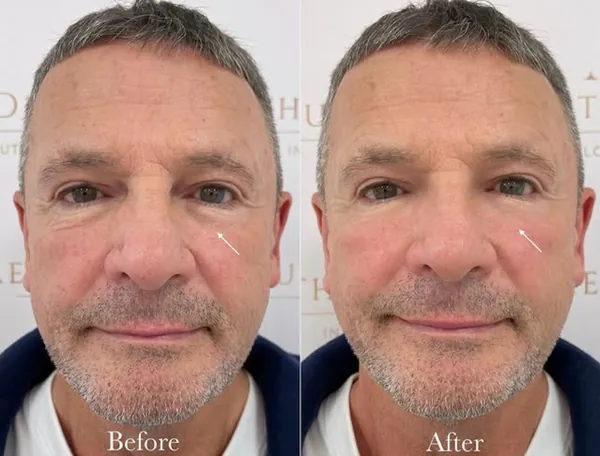 Facial rejuvenation result