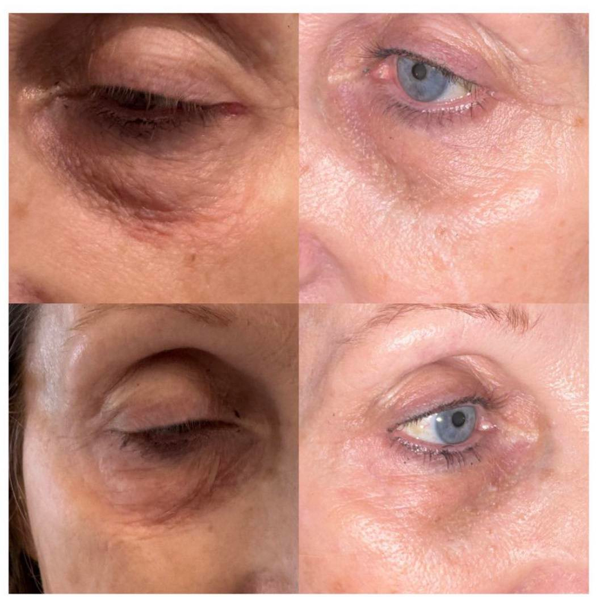 Under eye filler before and after result