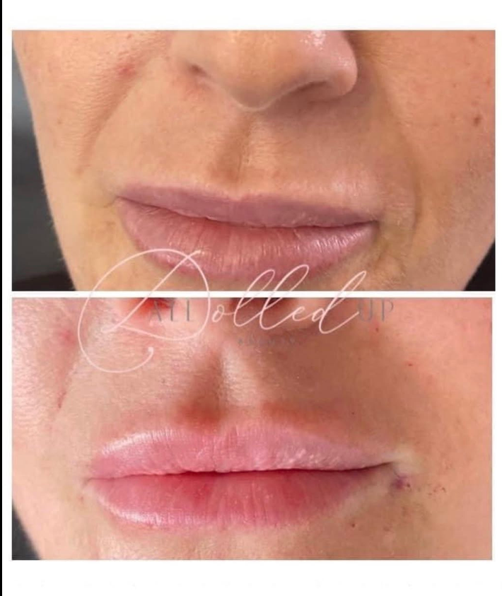 Lip filler result