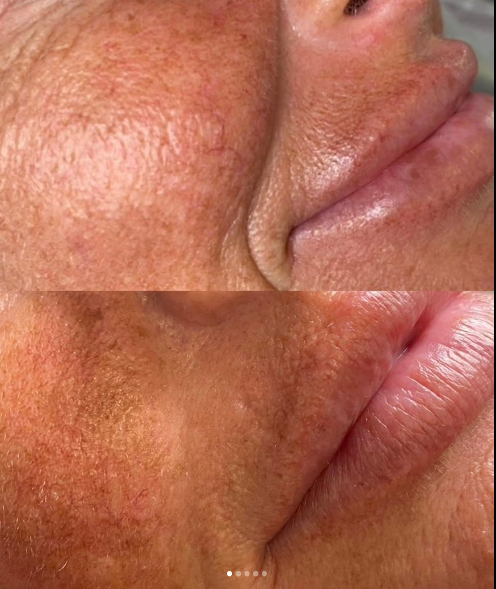 Skin rejuvenation before and after result
