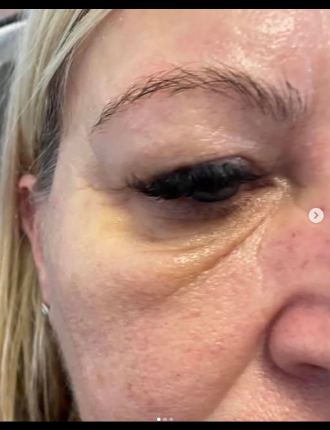 Glossy lip filler detail