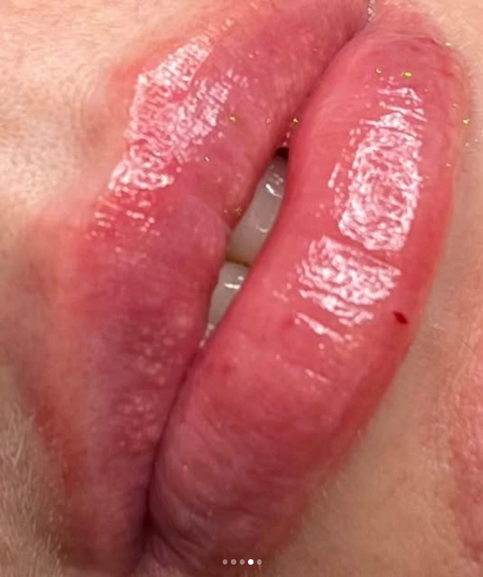 Natural lip filler detail