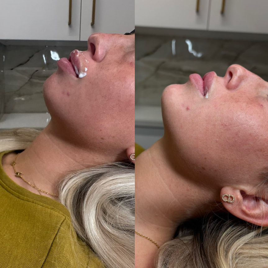 Dermal Fillers