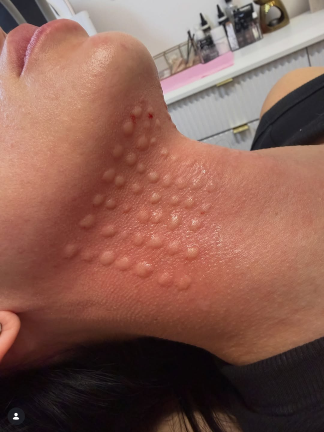Skin Boosters