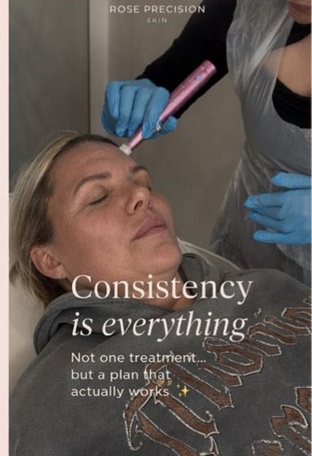 Microneedling Face and Neck
