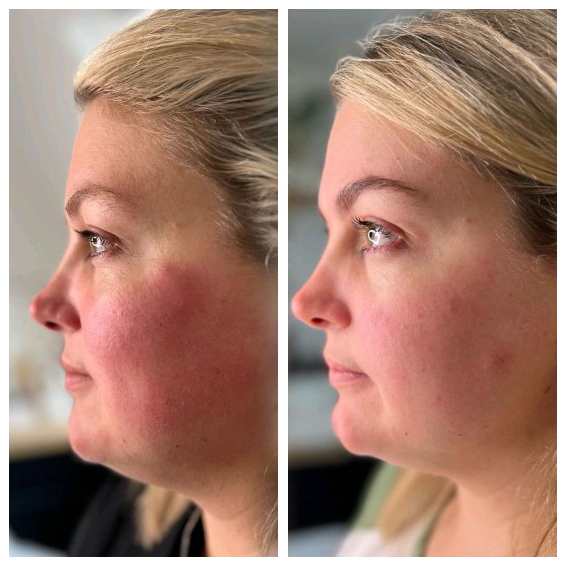 Skin Boosters